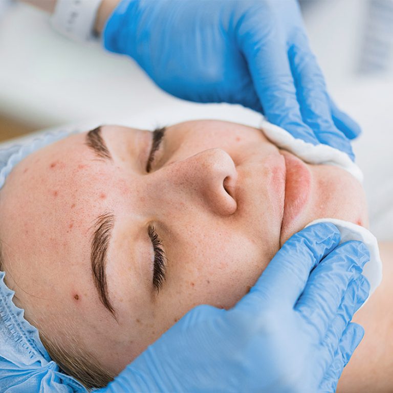 Acne Facial Treatment